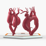 Ascending Aortic Aneurysms 1