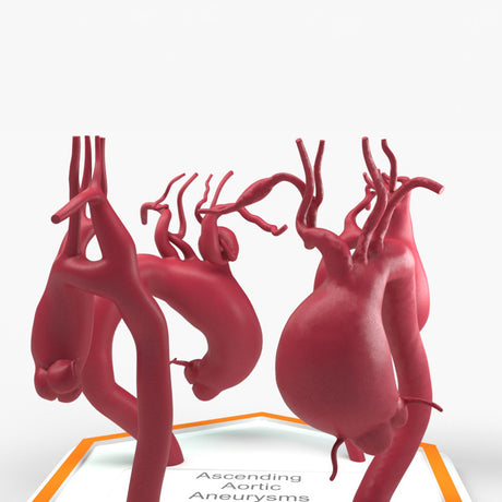 Ascending Aortic Aneurysms 1