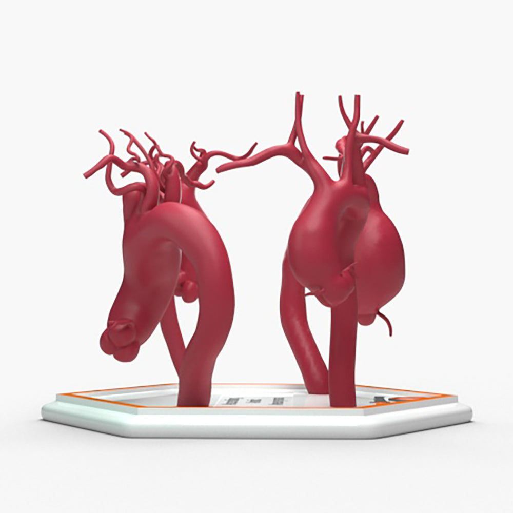 Ascending Aortic Aneurysms 1