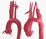 Ascending Supracoronary Aortic Aneurysm and Normal