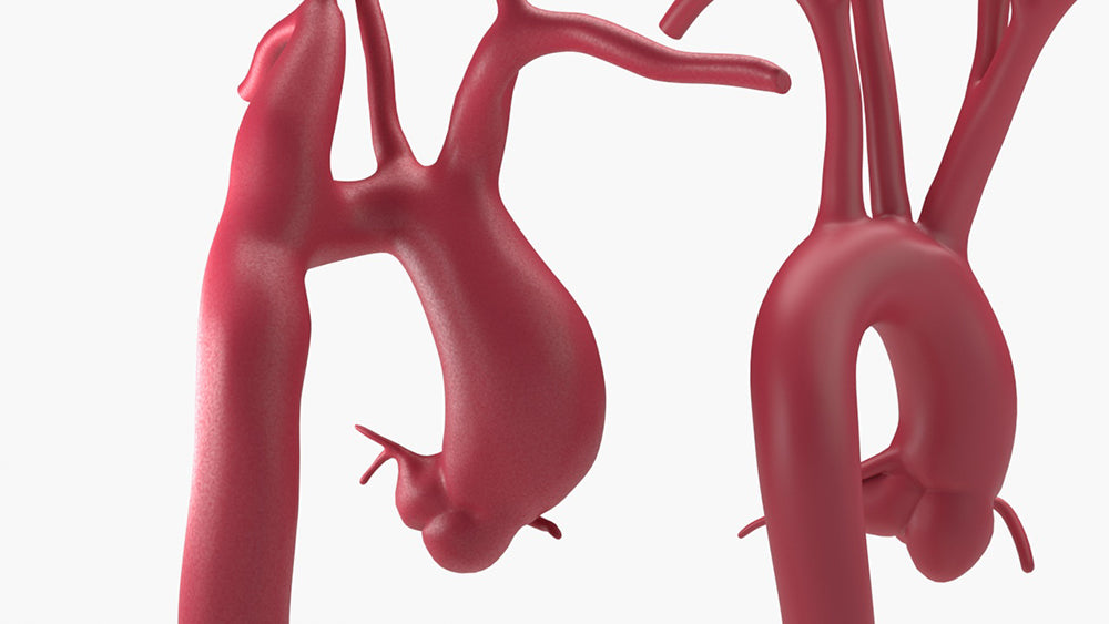 Ascending Supracoronary Aortic Aneurysm and Normal