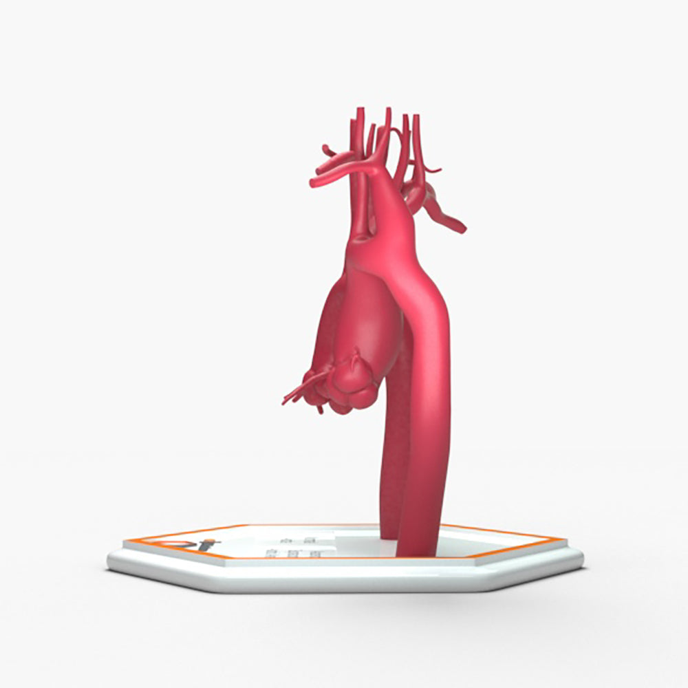 Ascending Supracoronary Aortic Aneurysm and Normal