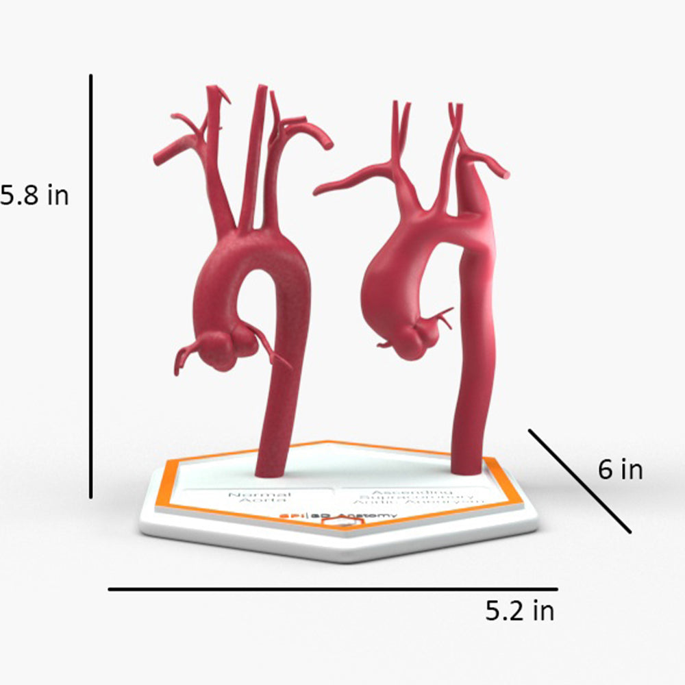 Ascending Supracoronary Aortic Aneurysm and Normal