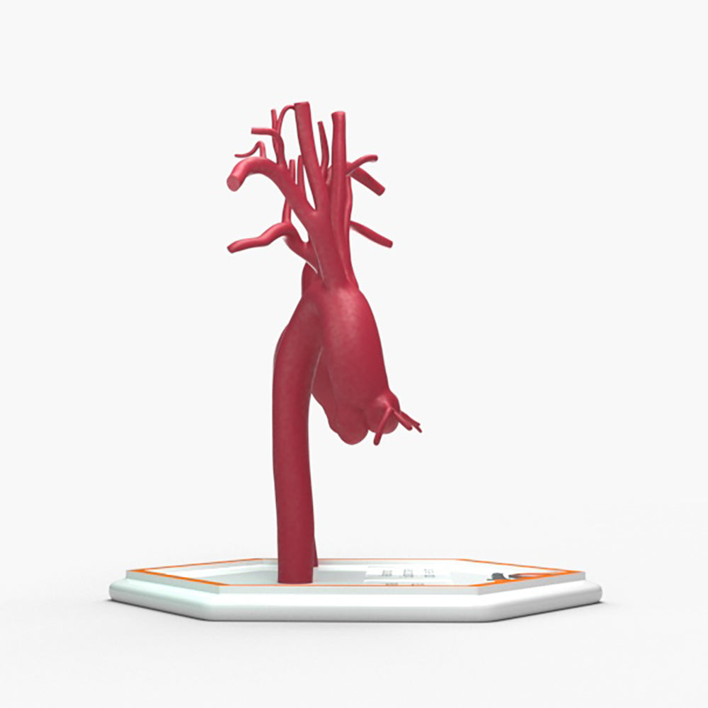 Ascending Supracoronary Aortic Aneurysm and Normal