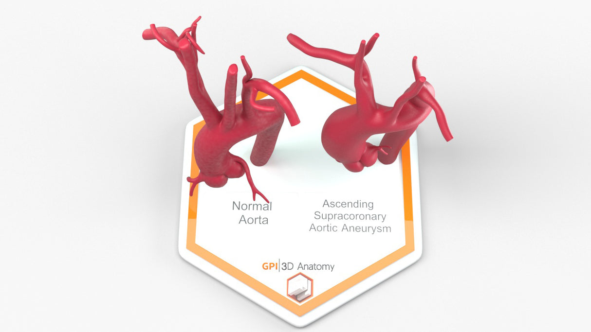 Ascending Supracoronary Aortic Aneurysm and Normal