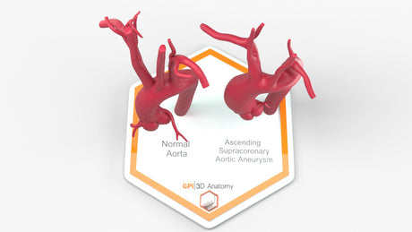 Ascending Supracoronary Aortic Aneurysm and Normal