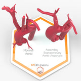 Ascending Supracoronary Aortic Aneurysm and Normal