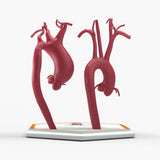 Supracoronary Ascending Aortic Aneurysm Left Carotid Variant and Normal