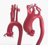 Supracoronary Ascending Aortic Aneurysm Left Carotid Variant and Normal