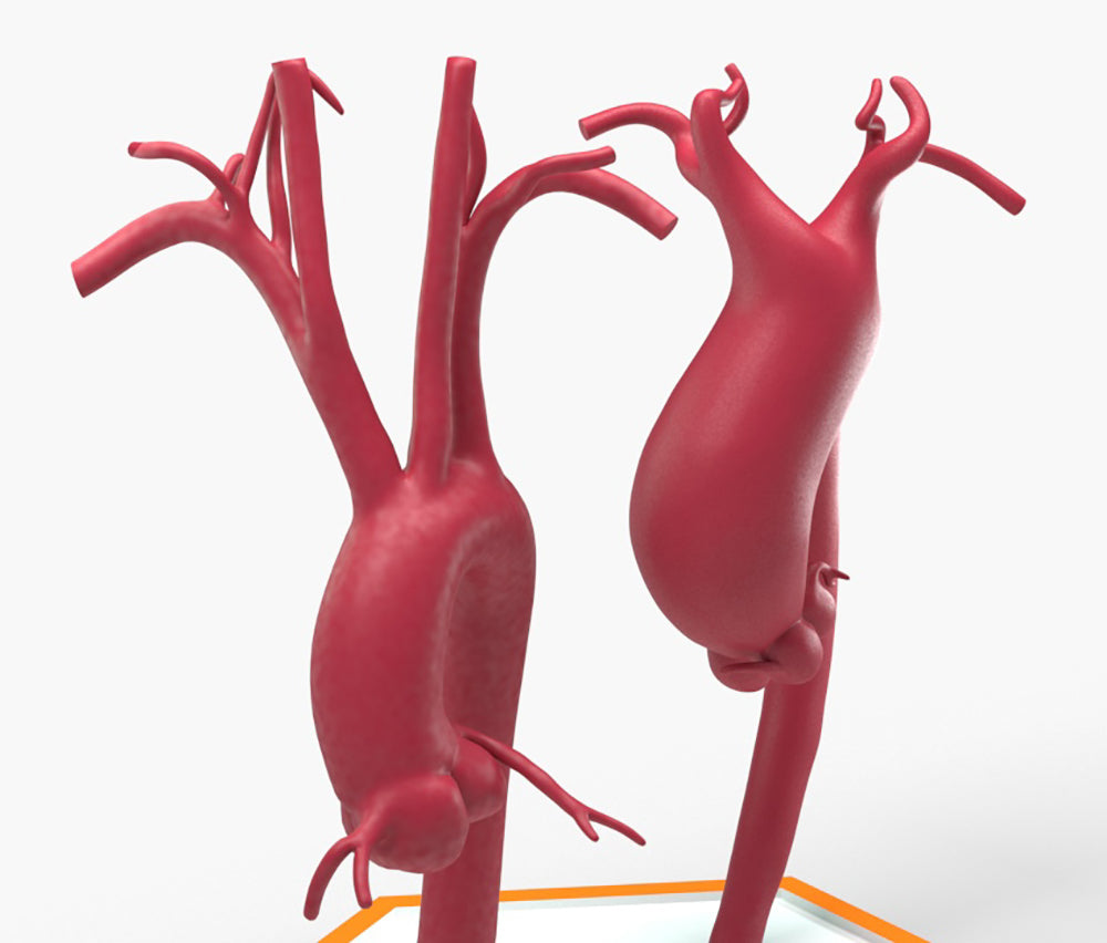 Supracoronary Ascending Aortic Aneurysm Left Carotid Variant and Normal