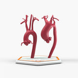 Supracoronary Ascending Aortic Aneurysm Left Carotid Variant and Normal