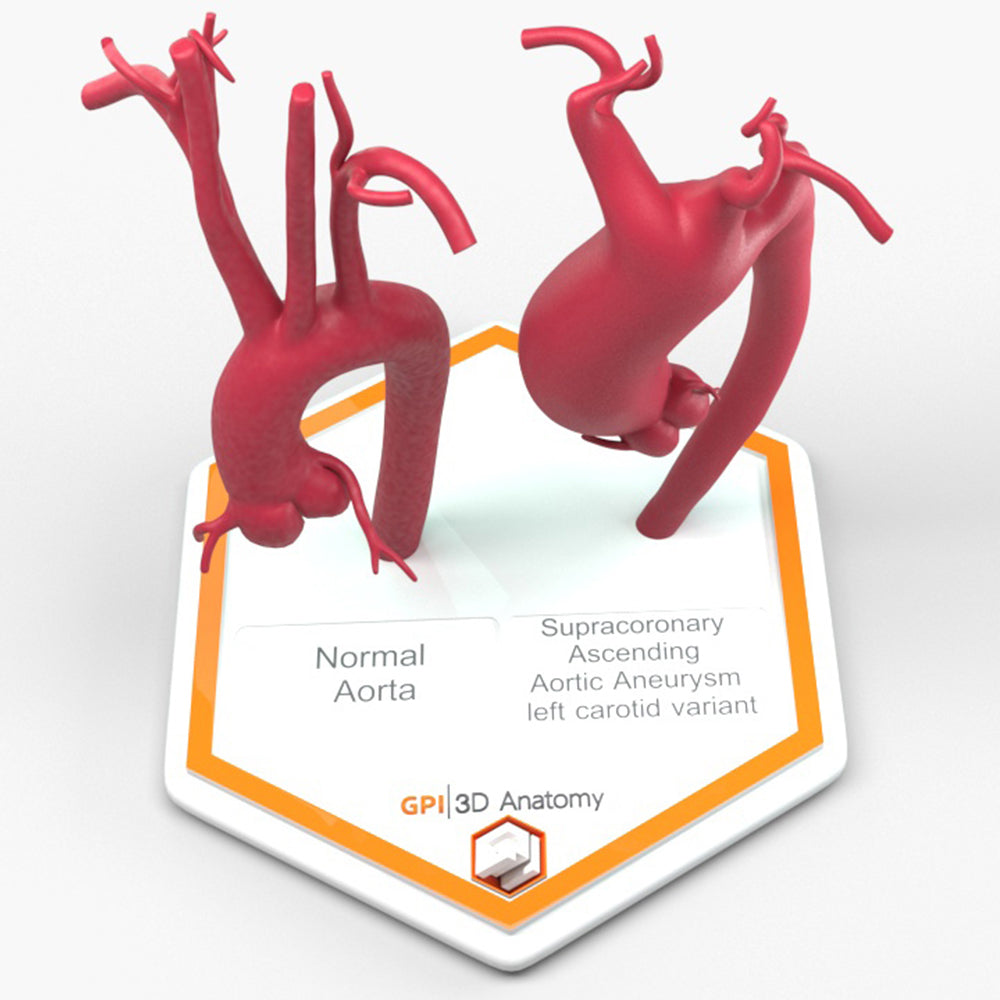 Supracoronary Ascending Aortic Aneurysm Left Carotid Variant and Normal