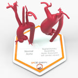 Supracoronary Ascending Aortic Aneurysm Left Carotid Variant and Normal