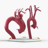 Ascending Supracoronary Aortic Arch and Innominate Artery Aneurysm and Normal