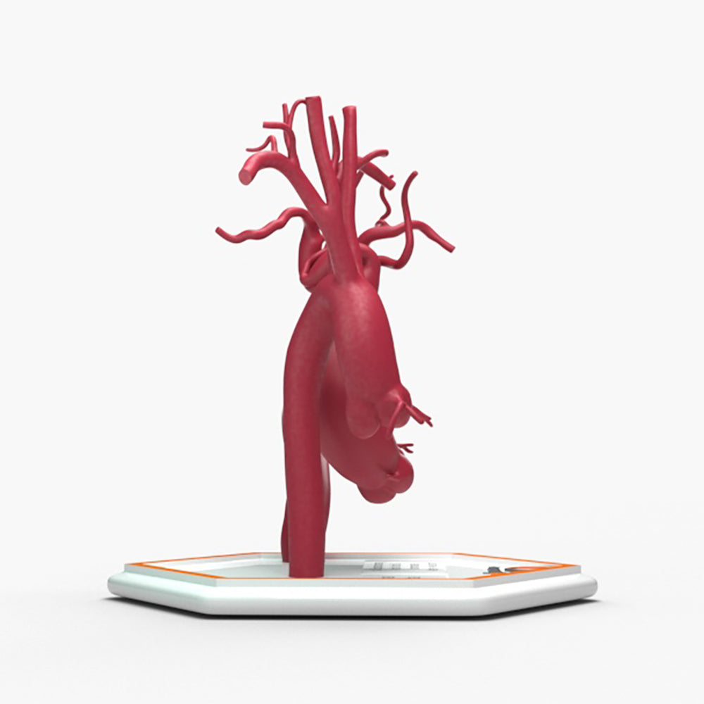 Ascending Supracoronary Aortic Arch and Innominate Artery Aneurysm and Normal
