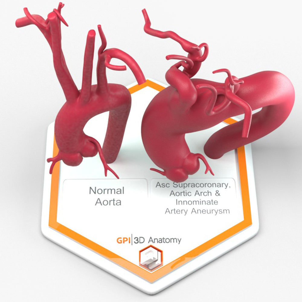 Ascending Supracoronary Aortic Arch and Innominate Artery Aneurysm and Normal
