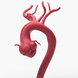 Marfanoid Aortic Root Aneurysm