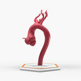 Marfanoid Aortic Root Aneurysm