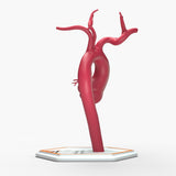 Marfanoid Aortic Root Aneurysm
