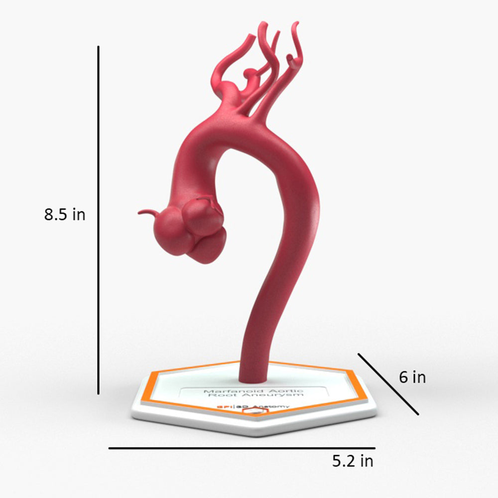 Marfanoid Aortic Root Aneurysm