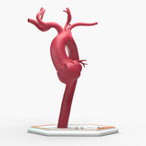 Marfanoid Aortic Root Aneurysm