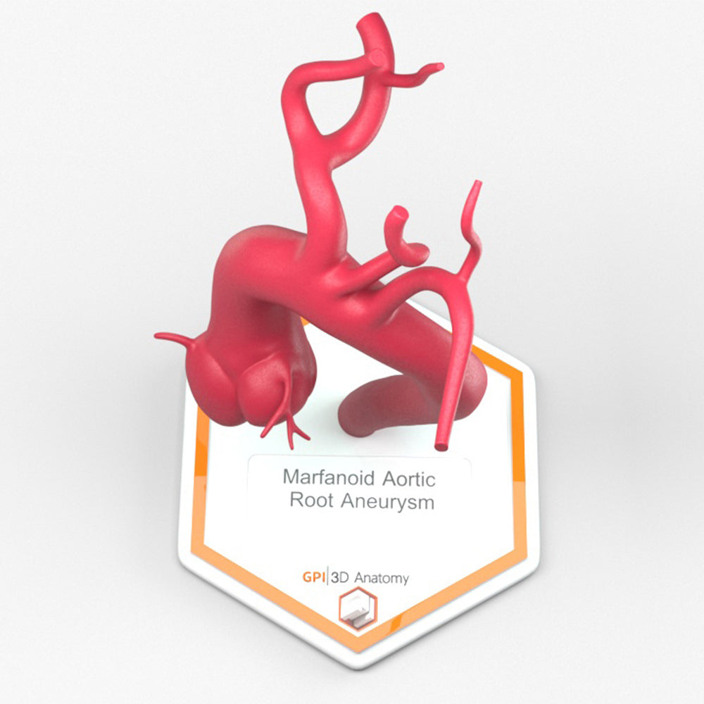 Marfanoid Aortic Root Aneurysm