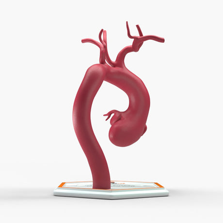 Marfanoid Aortic Root and Sinus of Valsalva Aneurysm