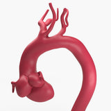 Marfanoid Aortic Root and Sinus of Valsalva Aneurysm