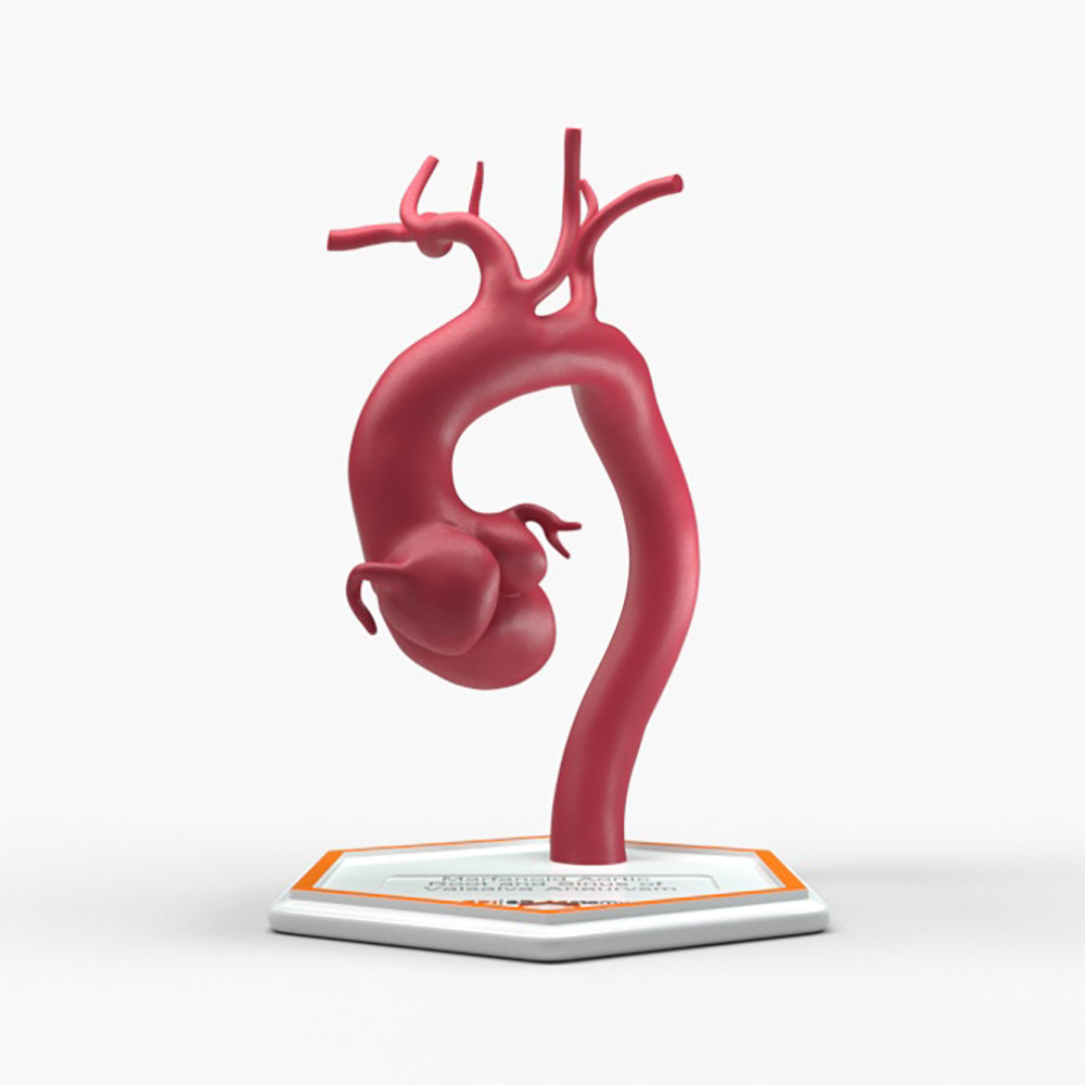 Marfanoid Aortic Root and Sinus of Valsalva Aneurysm