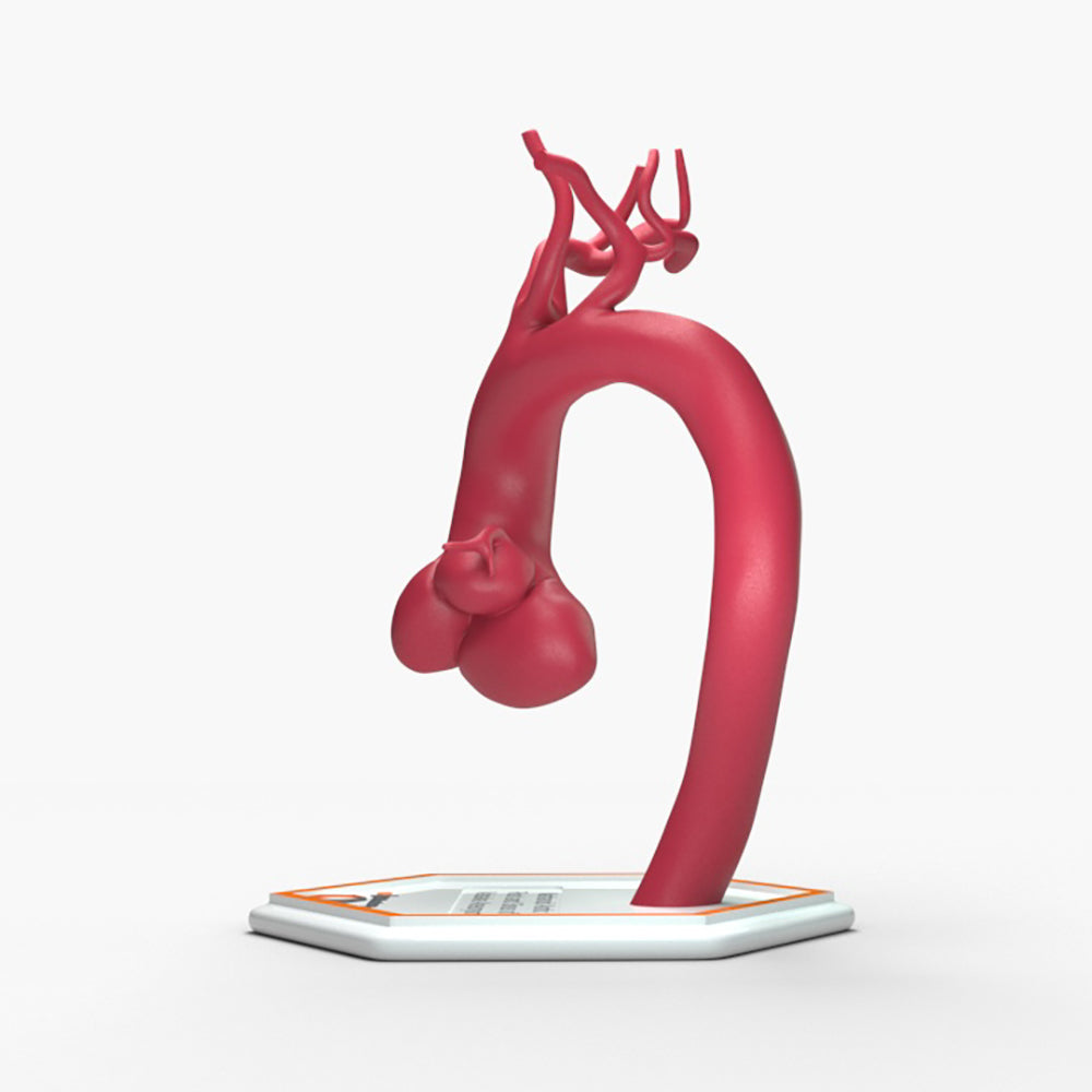 Marfanoid Aortic Root and Sinus of Valsalva Aneurysm