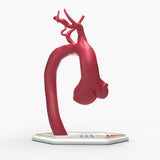 Marfanoid Aortic Root and Sinus of Valsalva Aneurysm
