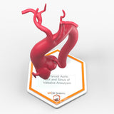 Marfanoid Aortic Root and Sinus of Valsalva Aneurysm