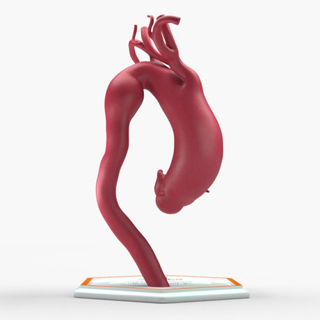 Fusiform Ascending & Descending Aortic Aneurysm 1