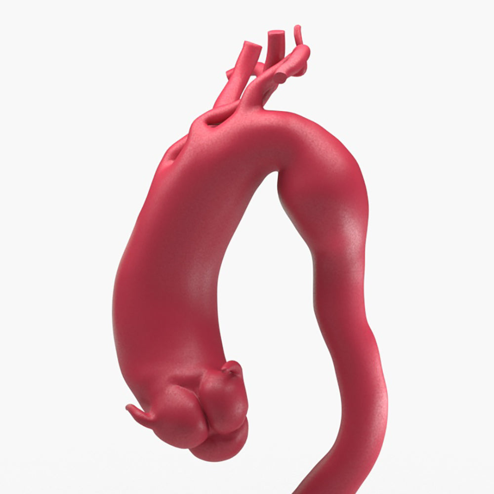 Fusiform Ascending & Descending Aortic Aneurysm 1