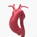 Fusiform Ascending & Descending Aortic Aneurysm 1