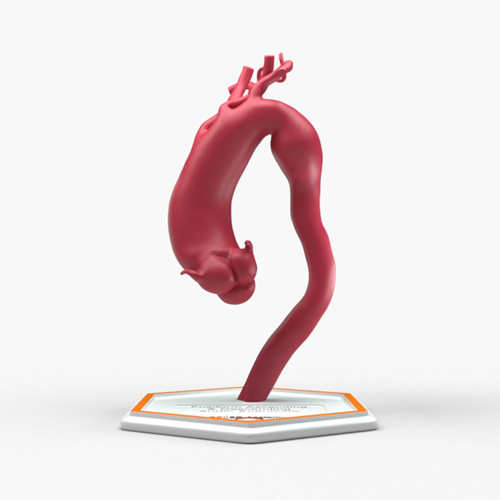Fusiform Ascending & Descending Aortic Aneurysm 1