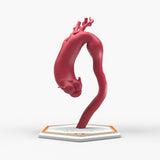 Fusiform Ascending & Descending Aortic Aneurysm 1