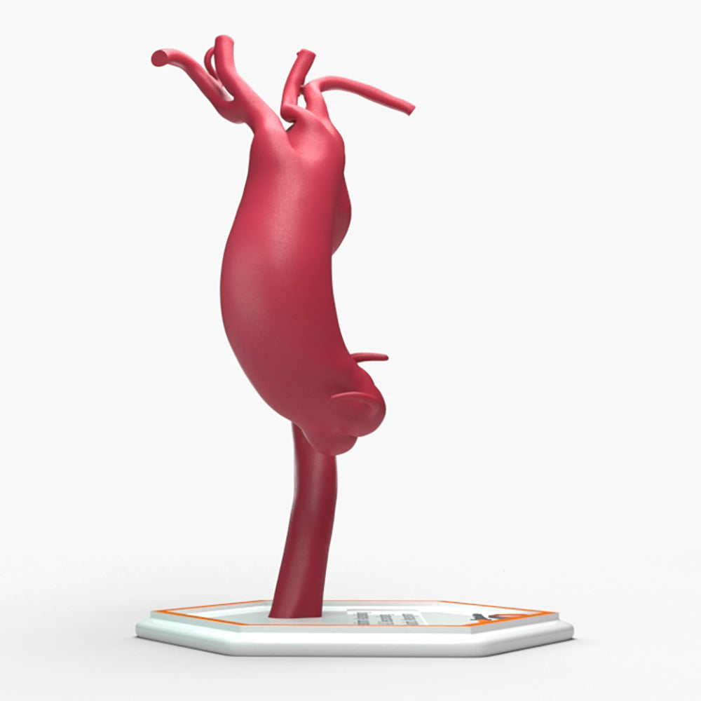 Fusiform Ascending & Descending Aortic Aneurysm 1