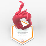 Fusiform Ascending & Descending Aortic Aneurysm 1