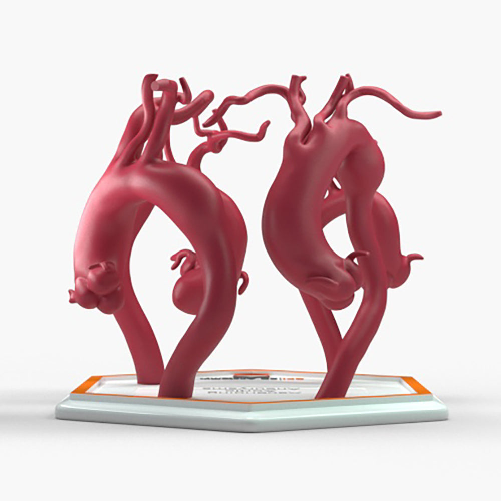 Ascending Aortic Aneurysms 2