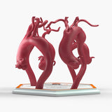 Ascending Aortic Aneurysms 2