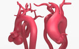 Ascending Aortic Aneurysms 2