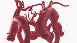 Ascending Aortic Aneurysms 2