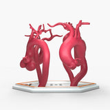 Ascending Aortic Aneurysms 2