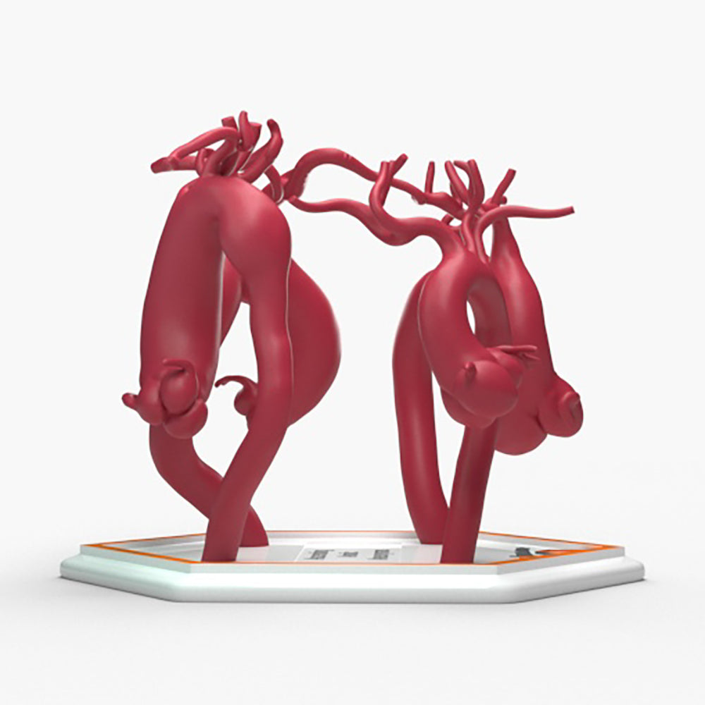 Ascending Aortic Aneurysms 2