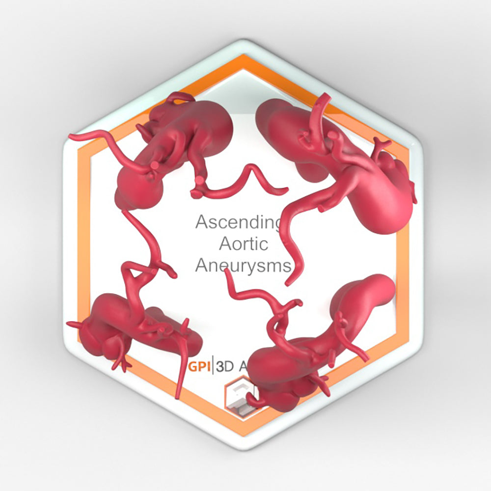 Ascending Aortic Aneurysms 2