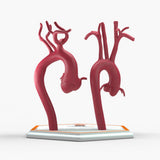 Marfanoid Aortic Root Aneurysm and Normal