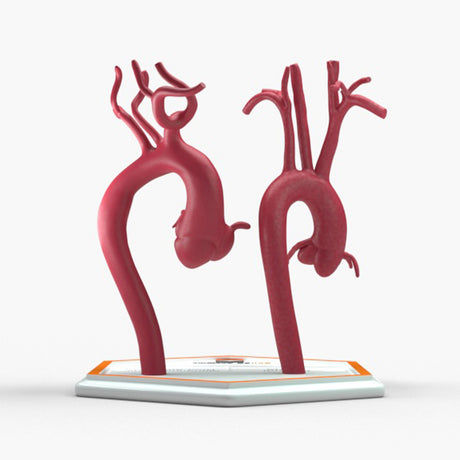 Marfanoid Aortic Root Aneurysm and Normal