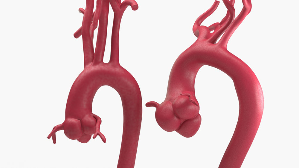 Marfanoid Aortic Root Aneurysm and Normal