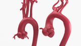 Marfanoid Aortic Root Aneurysm and Normal